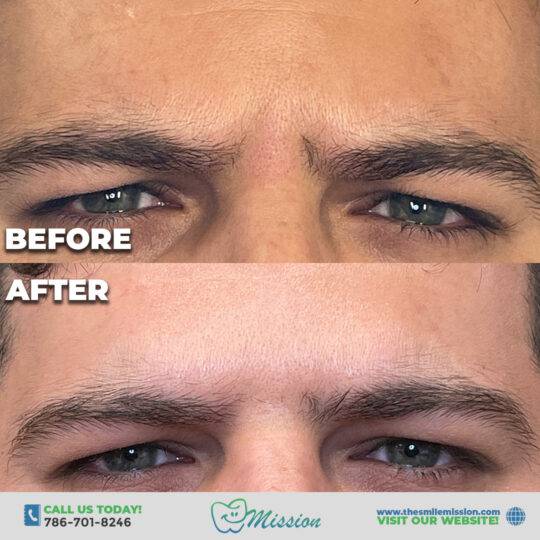 Botox 10 